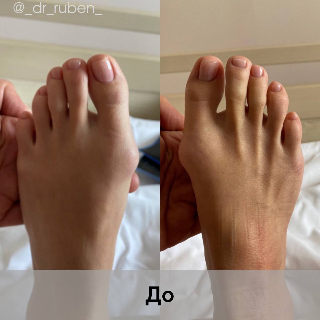 Как лечить деформацию большого пальца стопы