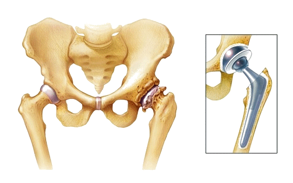 Эндопротезирование тазобедренного сустава