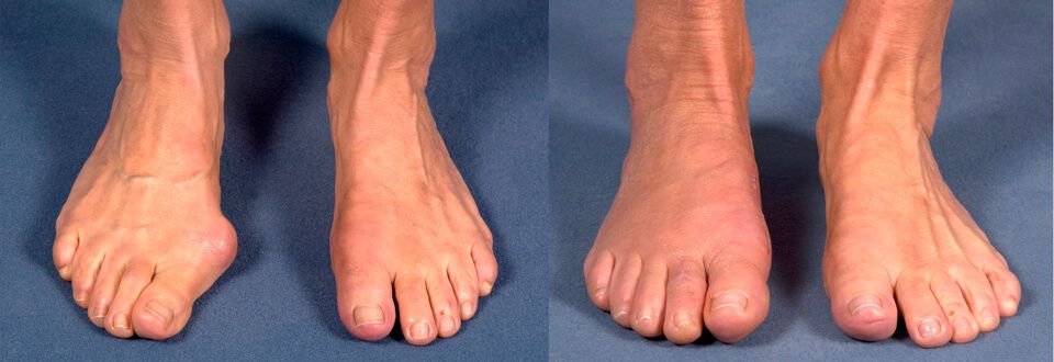 Стопы после операции Hallux Valgus 