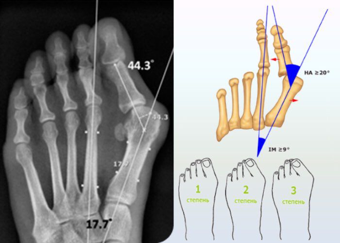 Стадии Hallux Valgus 