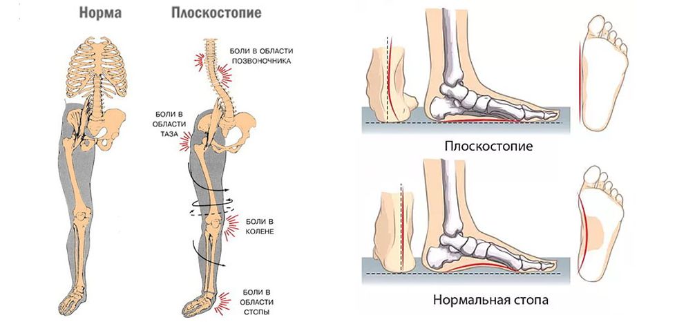 Что такое валы стоп