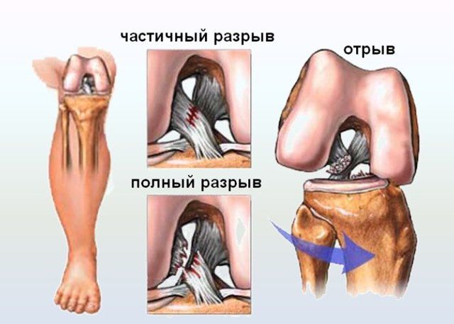 Что значит разволокнена связка передняя крестообразная связка