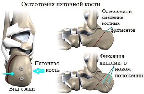 Пяточная кость после операции. Корригирующая остеотомия пяточной кости. Клиновидная остеотомия пяточной кости. Остеотомия пяточной кости при плоскостопии. Плоскостопие вальгусная стопа операция.