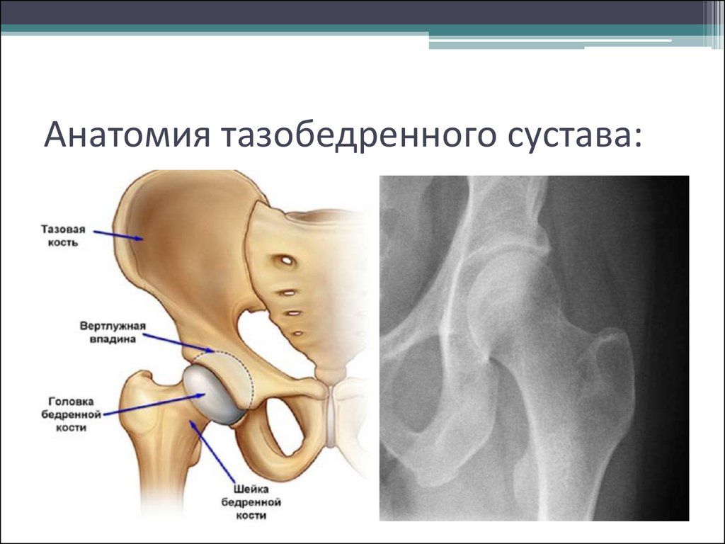 Мкб 10 асептический некроз головки бедренной