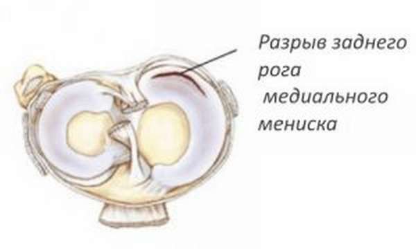 Задний рог медиального мениска фото