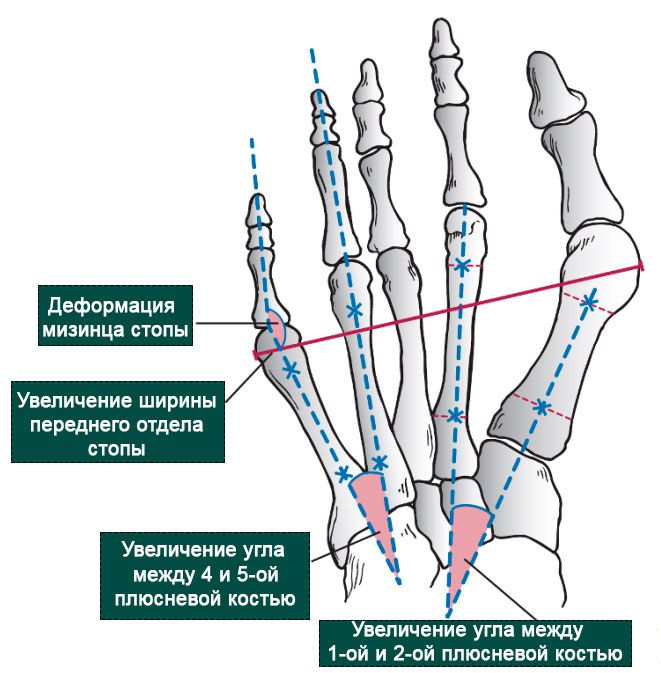 Высоко деформированные