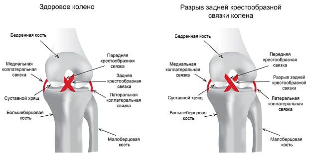 Здоровое колено и разрыв задней крестообразной связки