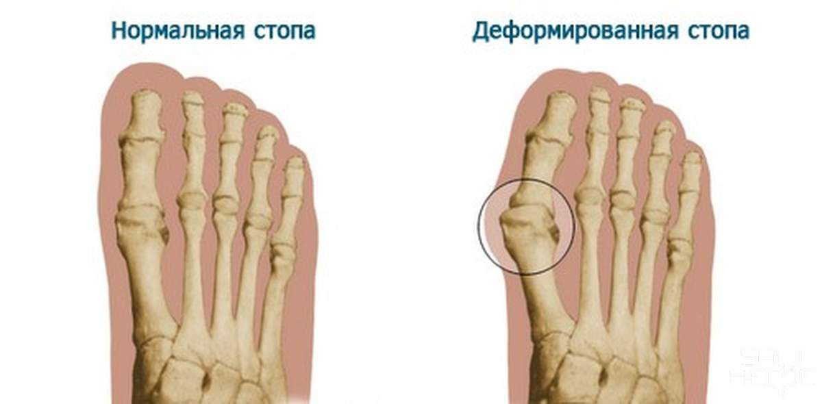 Растут кости на пальцах. Степени вальгусной деформации 1 пальца стопы рентген. Вальгусная деформация 1 пальца стопы. Халюс вальгус это поперечное плоскостопие.