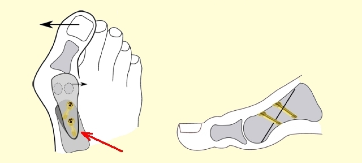 Лечение вальгуса операция. Операция по шеде при вальгусной деформации. Малоинвазивные операции вальгуса. Добавочный 1 пальца стопы операция.