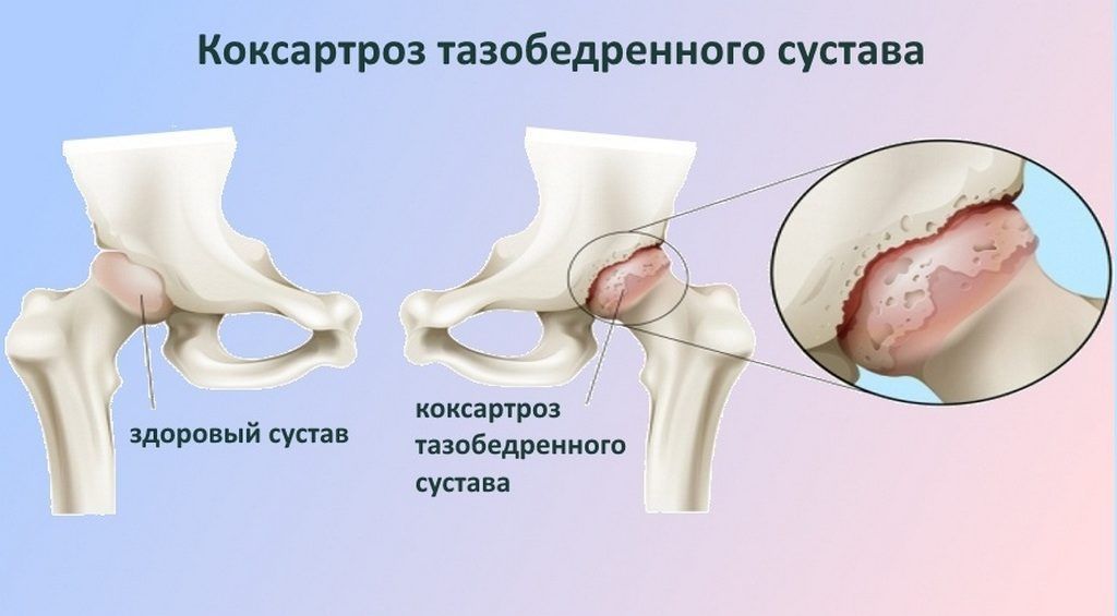 Заболевание коксартроз тазобедренного сустава. ТБС тазобедренного сустава. Микрос сустава тазобедренного сустава. Коксартроз 2-3 степени тазобедренного сустава.